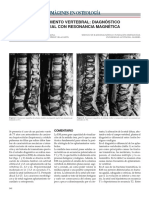 Aplastamiento Vertebral RMN