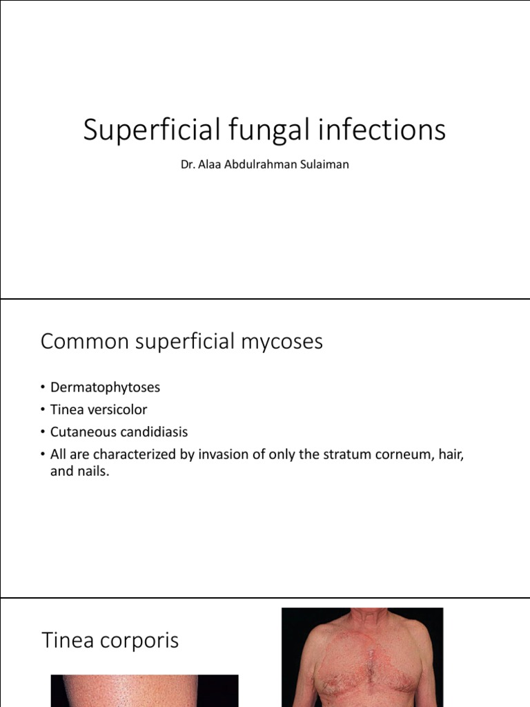 Superficial Fungal Infections Overview | PDF | Candidiasis | Dermatitis