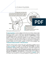 Cómo Reconocer El Cáncer de Próstata