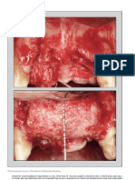 Surgical Management of Significant Maxillary Anterior Vertical Ridge Defects - Urban2016