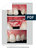 Cite Share Labial Strip Gingival Graft For The Reconstruction of Severely Distorted Mucogingival Defects - Urban 2020