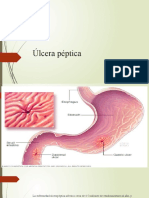 Úlcera Péptica