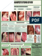 Oral Manifestation of Hiv