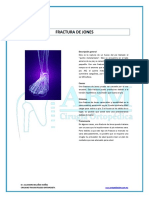 Fractura de Jones