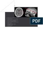 Normal Head CT Scan