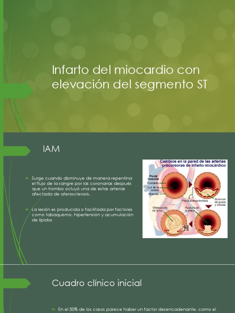 Infarto Del Miocardio - Elevación Del Segmento ST | PDF ...