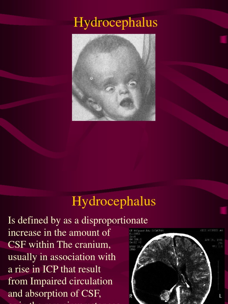 Hydrocephalus | PDF | Cerebrospinal Fluid | Nervous System