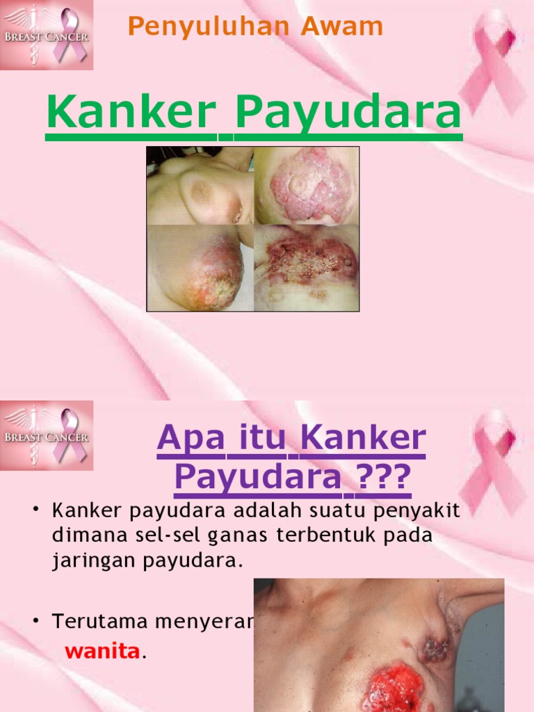 Kanker Payudara | PDF | Kesehatan Holistik | Gaya Hidup