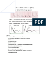 The Spiked Helmet Sign and J Wave Relatinship