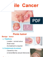 Penis Cancer