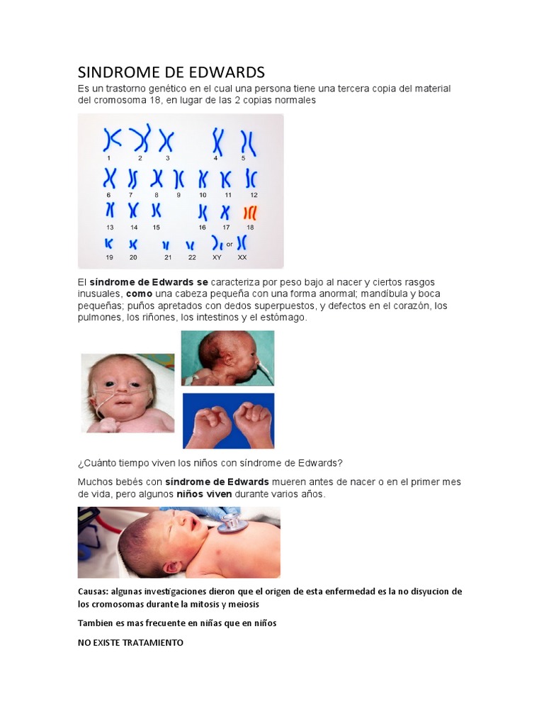 SINDROME DE EDWARDS Presentacion July | PDF