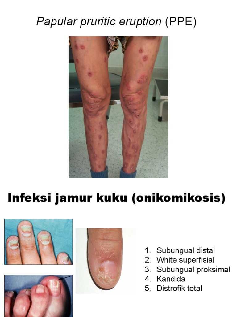 Informasi Dasar HIV AIDS Dan Stadium Klinis | PDF