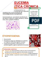 Leucemia Linfocitica Cronica