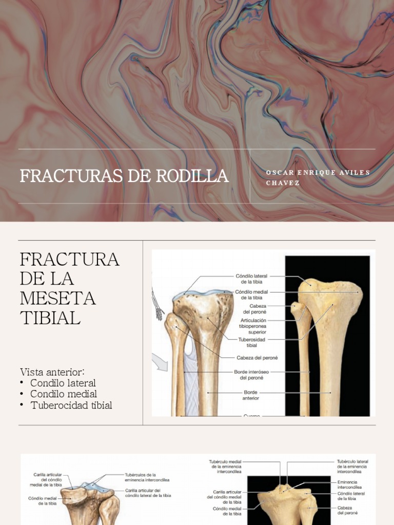 Fracturas de Rodilla | PDF