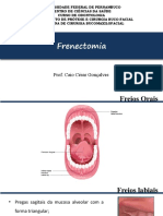 Frenectomia - UFPE