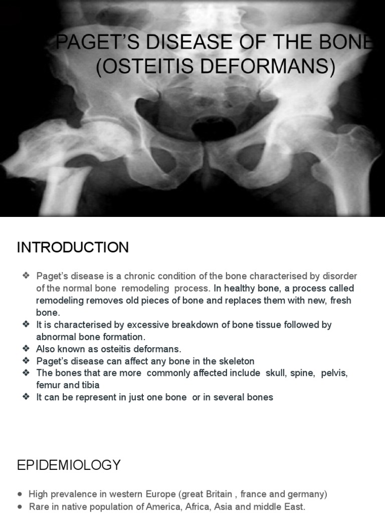 Understanding Paget's Disease of Bone | PDF | Bone | Skeletal System