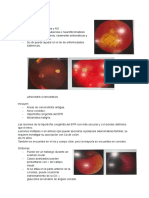 Tumores Retinianos