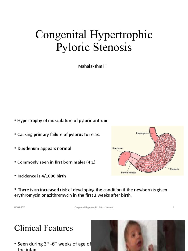 Congenital Hypertrophic Pyloric Stenosis | PDF
