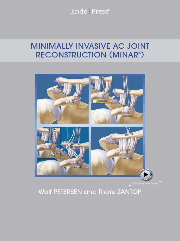 Minimal Imvasive AC Joint Recontruction | PDF | Musculoskeletal System ...