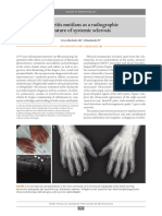 1320 Arthritis Mutilans As A Radiographic Feature of Systemic Sclerosis File