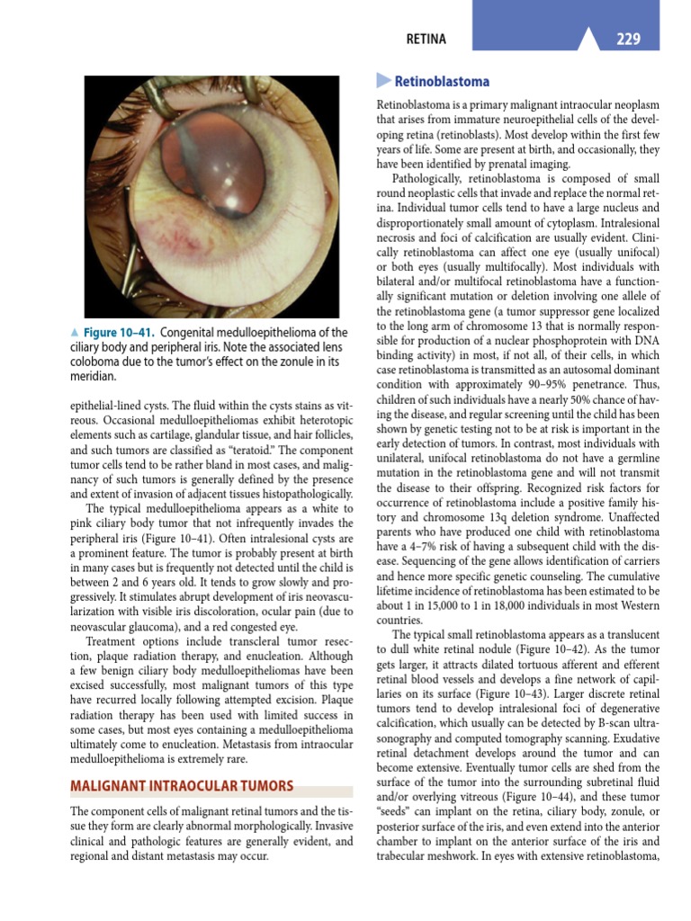 Leukocoria (Retinoblastoma) PDF