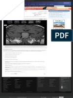 Pituitary Macroadenoma Radiology Case