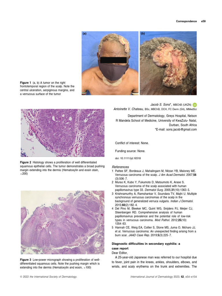 Int J Dermatology 2022 Iwasawa Diagnostic Difficulties in Secondary Syphilis A Case Report