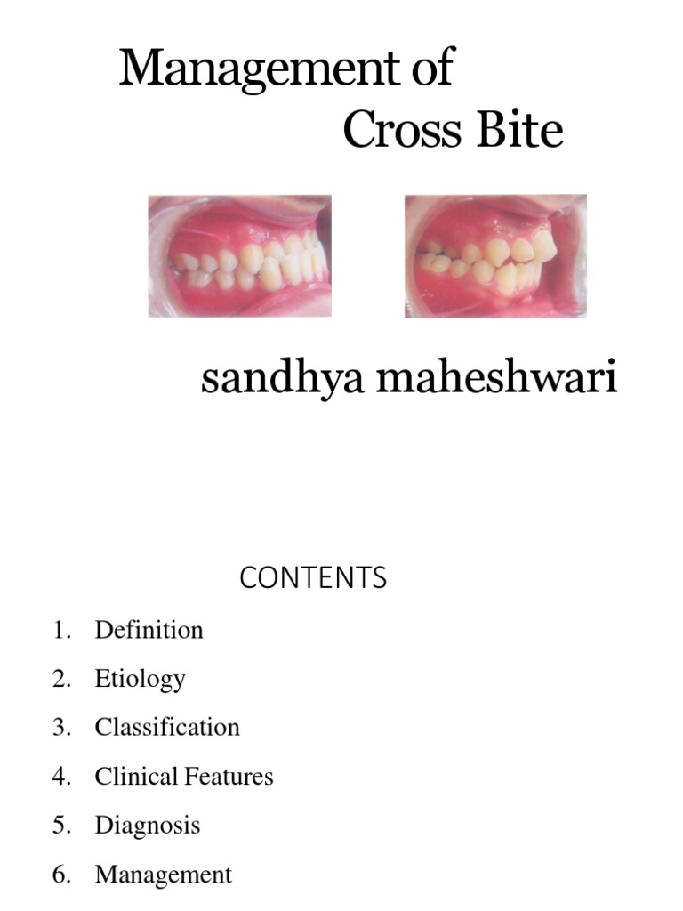 Management of Cross Bite: Sandhya Maheshwari | PDF