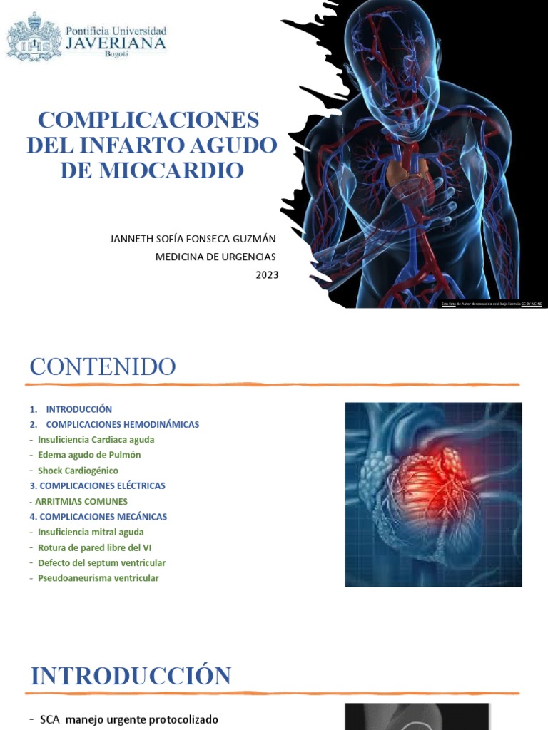 Complicaciones Del Sca | Descargar gratis PDF | Infarto de miocardio ...
