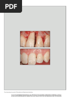 Revisiting Miller's Classification of Recession | PDF | Periodontology ...
