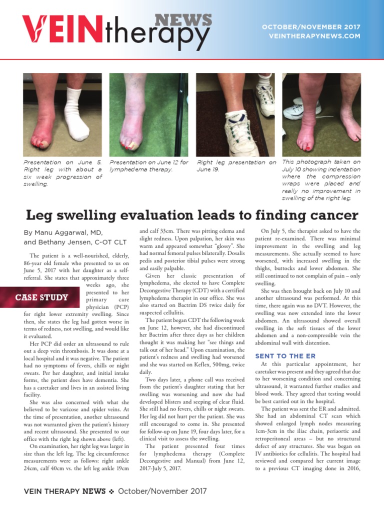 Leg Swelling Evaluation Leads To Finding Cancer | PDF | Edema | Causes ...