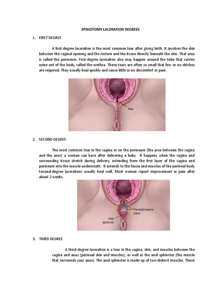 episiotomy-laceration-degrees-pdf
