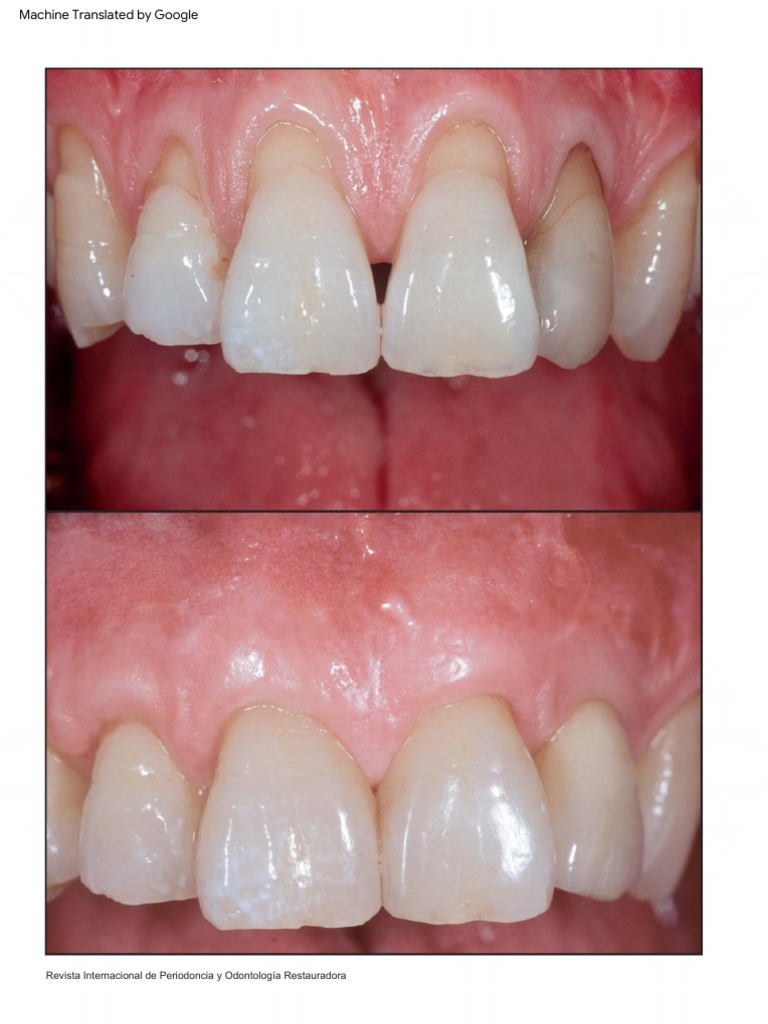 Kit D'Instruments Chirurgicaux Dentaires En Acier Inoxydable - Greffe Gingivale, Tunneling Parodontal Mauri