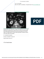 CT of a Ureteral Stone - UpToDate