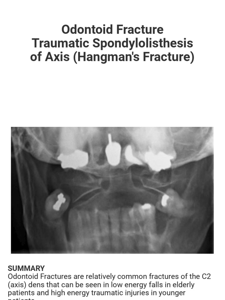 File:Hangman's fracture.jpg - Wikimedia Commons, image size:768x1024