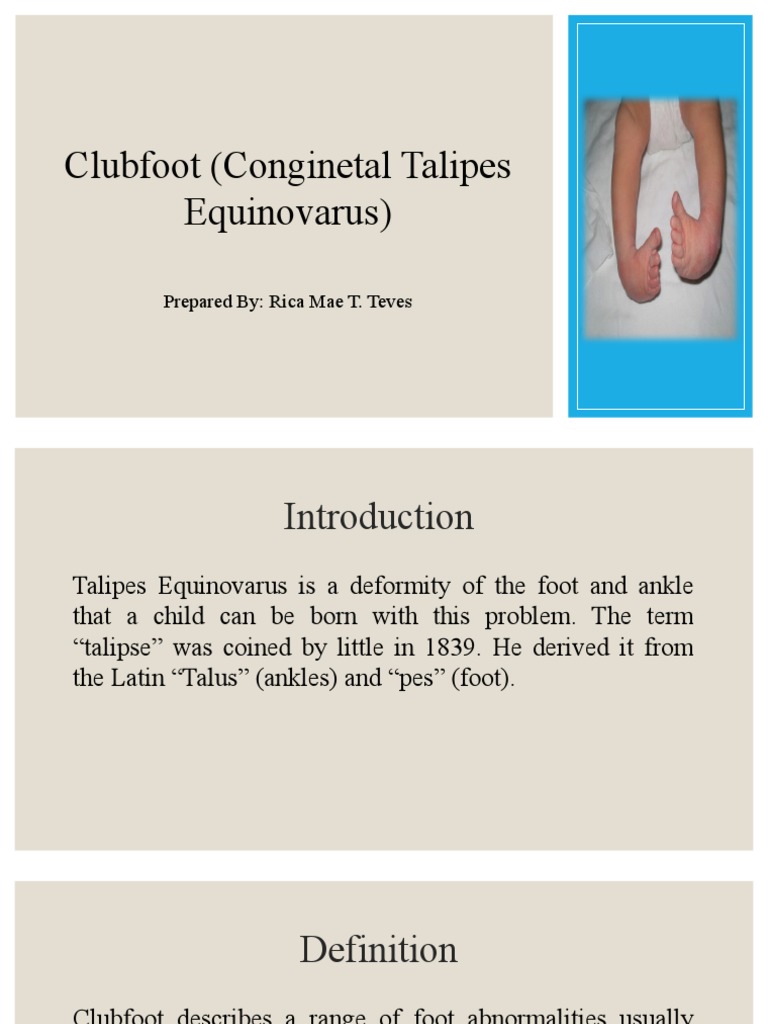 CLUBFOOT | PDF