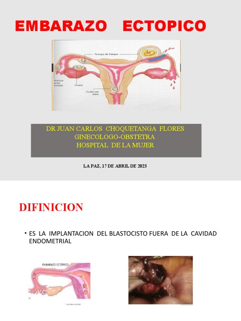 Manejo del Embarazo Ectópico | PDF | El embarazo | Especialidades Medicas