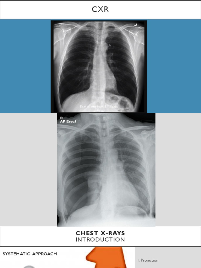 Comprehensive Chest X-Ray Guide | PDF | Thorax | Lung