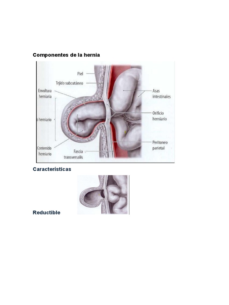 Hernias de La Pared Abdominal | PDF | Cirugía | Abdomen