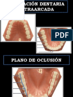 Alineación Dentaria Intraarcada