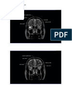 Mri Brain Coronal View