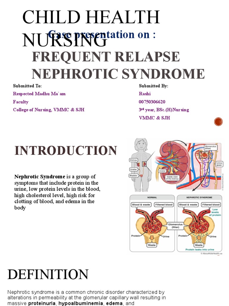 Nephrotic Syndromee PDF Edema Animal Anatomy