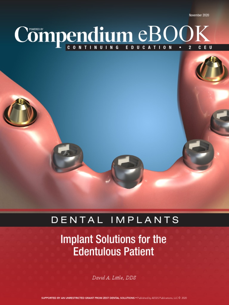 Implant Solutions For The Edentulous Patient PDF