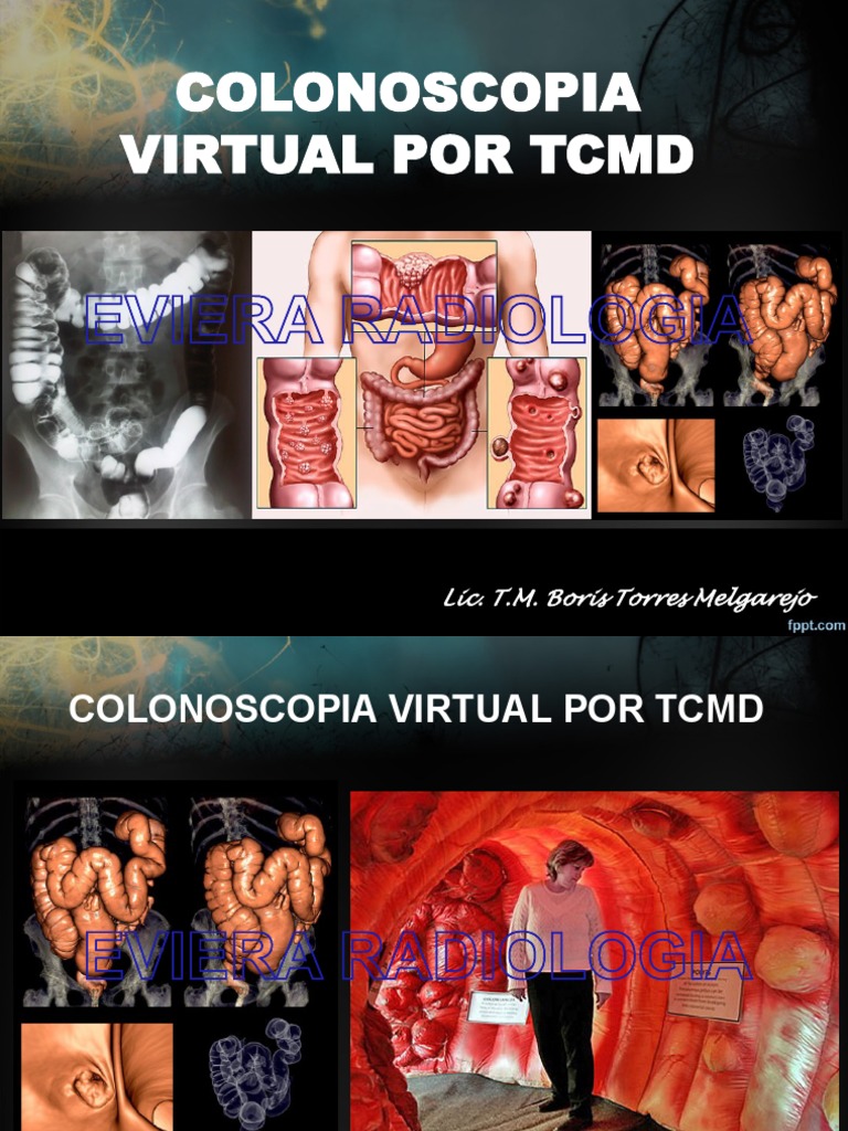 Colonoscopia Virtual: Ventajas y Procedimiento | PDF | Cáncer ...