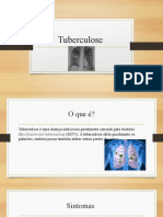 Tuberculose