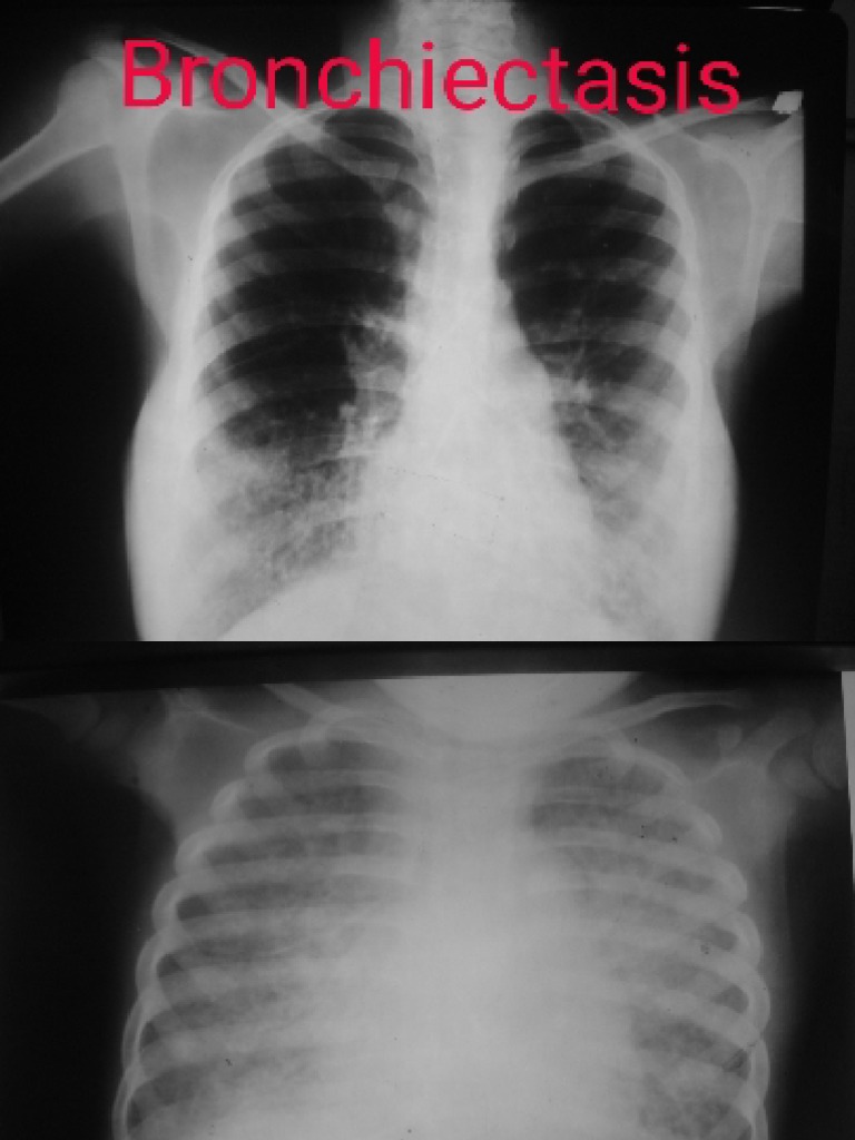 Pediatric chest x ray pdf