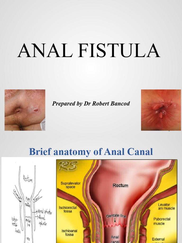 Understanding Anal Fistulas: Causes & Treatment | PDF | Clinical ...