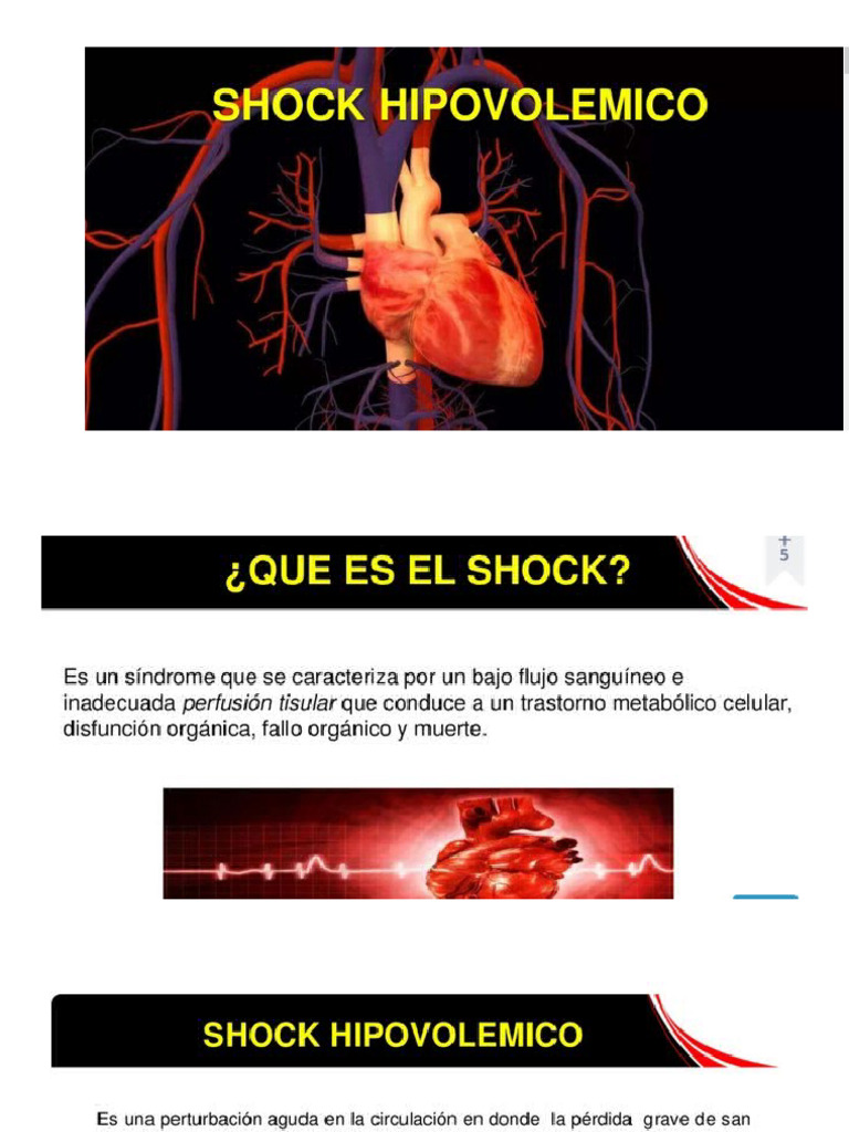 Manejo del Shock Hipovolémico | PDF | Medicina CLINICA | Emergencias ...