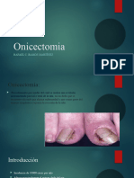 Onicectomia