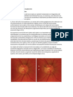 Exploración Del Nervio Óptico: Examen de Fondo de Ojo Con Glaucoma